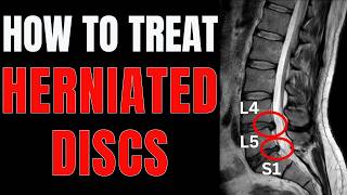 Herniated Disc at L4L5 or L5S1 Simple Tips to Relieve Back Pain [upl. by Niveg]