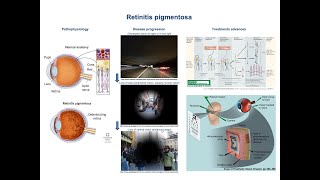 Retinitis pigmentosa pathophysiology and treatment advances [upl. by Oibaf]