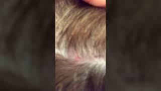 12718 Sores on scalp from targeting [upl. by Colver]