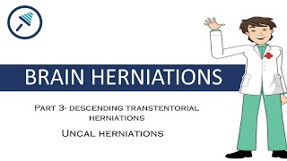 BRAIN HERNIATIONS 34  Uncal herniation [upl. by Nhtanhoj]