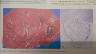 Acute Pyelonephritis  SPECIAL PATHOLOGY [upl. by Eirrek]