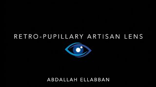 Aphakia Correction  Retropupillary Artisan Lens [upl. by Albie]