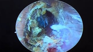 Fungal Ear Infection Cleaning earwax Cleaning earwaxremoval satisfying doctoranh [upl. by Nodnnarb]