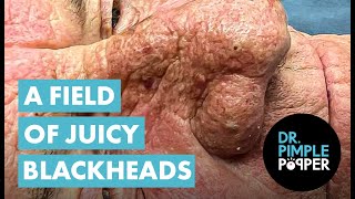 A FIELD OF JUICY BLACKHEADS [upl. by Wey403]