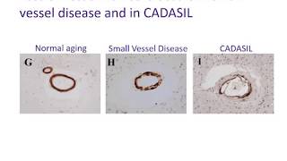 002 Small vessel disease amp CADASIL [upl. by Sukcirdor]