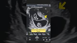 “Key Ultrasound Findings in Dichorionic Diamniotic Twins” [upl. by Garfinkel]