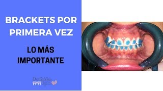 BRACKETS POR PRIMERA VEZ  Lo que debes saber de Ortodoncia [upl. by Sonya]