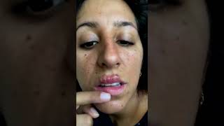 Cystic acne and blackheads removal  Newest pimple pops for 2022 [upl. by Ambert]