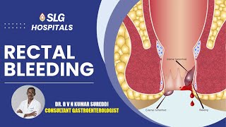 Symptoms of Rectal Bleeding  Dr B V N Kumar Sureddi Gastroenterologist amp Medical Gastroenterology [upl. by Ogren]