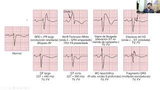 Cardiologia Diagnóstico y manejo de TAQUICARDIA VENTRICULAR [upl. by Nylitsirk]