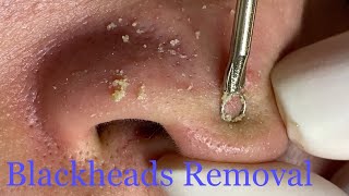 70  2024 Blackheads Removal  LyLyBeautySpa [upl. by Milurd]