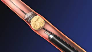 CoAx 10mm Stone Control Catheter from Accordion Medical [upl. by Ahsyak]