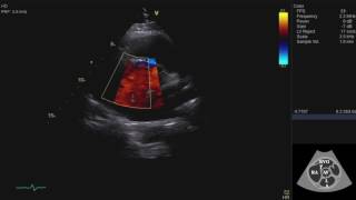 Echocardiography Essentials Mastering the parasternal short axis PSAX view of the aortic valve [upl. by Joachima]