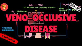 VENOOCCLUSIVE DISEASE Hemodynamics Mechanism of clinical symptoms [upl. by Okomom]