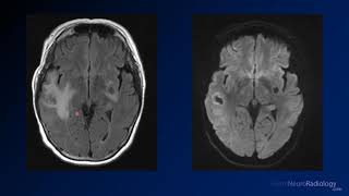 Imaging brain tumors  5  Non glial tumors [upl. by Federica]