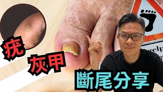 灰甲，病毒疣 有乜好怕。同你分享處理同戰鬥親身經驗。灰甲 疣 真菌 病毒 香港腳 [upl. by Ly]