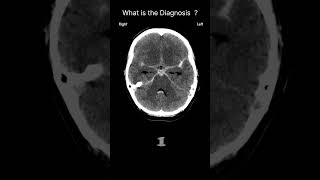 Subarachnoid haemorrhage  CT brain Acute CT Brain Extraaxial hemorrhage 66 radiologychannel007 [upl. by Gilud52]