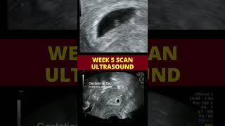 Ultrasound scan week 5  pregnancy scan [upl. by Heddi169]