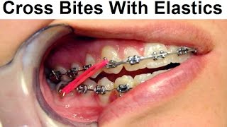 Correcting Cross Bite Using Orthodontic Elastics by Dr Mike Mew [upl. by Bostow]