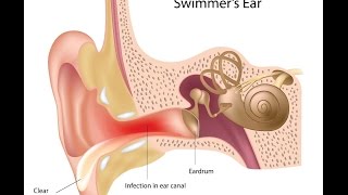 Otitis Externa [upl. by Rehtul]