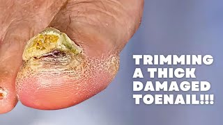 Trimming a THICK DAMAGED Toenail [upl. by Hassadah]