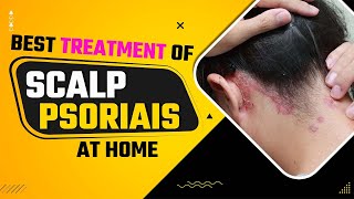 Scalp Psoriasis Removal Home Remedies  Best Treatment Of Scalp Psoriais At Home  Dr Health [upl. by Nosemyaj96]