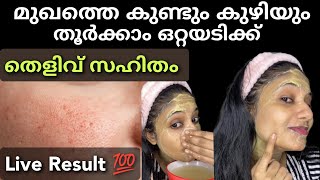 കുഴികളും പാടുകളും പമ്പകടന്നു Open pores removal Naturally at home malayalam  Athira balaji [upl. by Dolora]