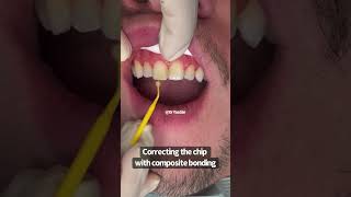 Fixing a chipped front tooth  composite bonding  Cosmetic Dentist Dr Yazdan [upl. by Yelrihs598]