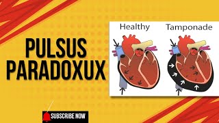 PULSUS PARADOXUS Definition Mechanism Causes [upl. by Astri]