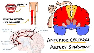 Anterior Cerebral Artery Stroke Syndrome  ACA Stroke Syndrome  Stroke Syndromes [upl. by Fasta]