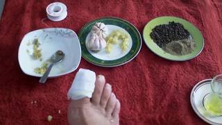 CHAMPIGNON DES ONGLES TRAITEMENT NATUREL معالجة فطر أظافر القدمين [upl. by Ertha]