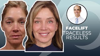 10 YEARS YOUNGER Traceless Facelift Surgery Before and After  Dr David Stoker [upl. by Eniamreg298]