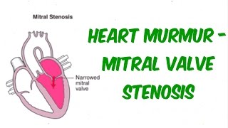 Mitral Stenosis  Auscultation Sound [upl. by Parik]