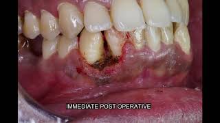 Oral Pyogenic Granuloma Treatment in Bangalore  Dental Solutions Bangalore [upl. by Eirac]