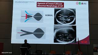 Video 2 Corpus Callosum Diagnosis [upl. by Aimal255]