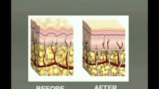 Fat reduction with Injection Lipolysis  Lipodissolve [upl. by Karilla]