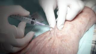 Aspiration of ganglion cyst [upl. by Orelu]