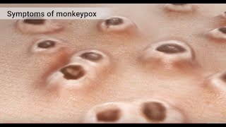 Mpox Monkeypox Animation [upl. by Hakaber]