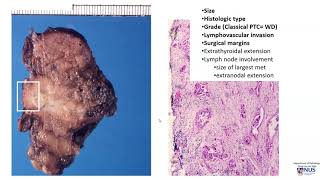 Thyroid carcinoma II Pathology evaluation [upl. by Silenay]