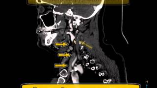 КТ при патологической извитости ВСА [upl. by Je]