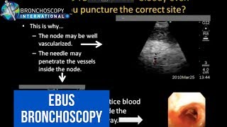 EBUS Bronchoscopy Curiosities [upl. by Ahsiam204]