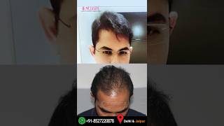 The Best HairTrans Results India by Dr Suneet Soni at Medispa Hair Transplant Centre 4500 Grafts [upl. by Plafker424]