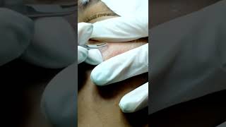 The Blackhead Extractions Breakthrough [upl. by Blasien228]