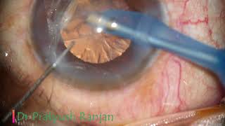 Phaco with Optical Iridectomy [upl. by Drwde]