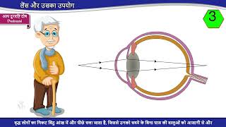 Types of defects of vision Hindi  दृष्टि दोष के प्रकार [upl. by Pet527]