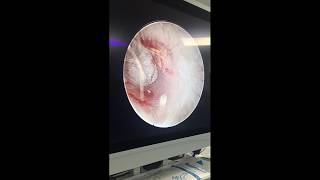 surfers ear  exostosis ear  endoscopic excision simple [upl. by Eislrahc]