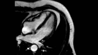 Constrictive pericarditis fourchamber ECGgated cine SSFP MR [upl. by Cruz467]