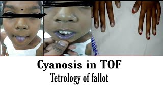 Tetrology of Fallot  TOF  Central cyanosis DrGurukumar [upl. by Princess]