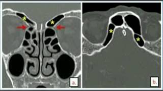 Supraorbital Ethmoidal Air Cells [upl. by Fiorenza]