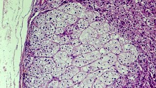 What is Hyperplasia  Pathology mini tutorial [upl. by Cnut244]